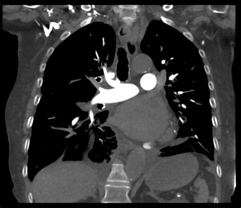 Interstitial Pulmonary Edema Image