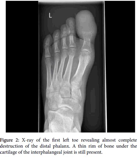 Metatarsal Bone Cyst