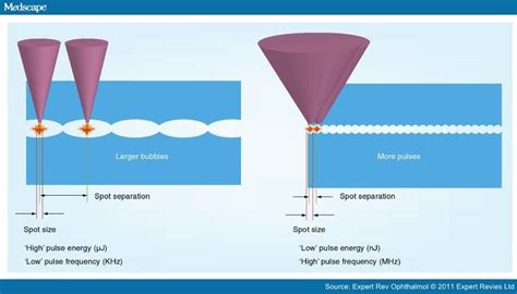 Refractive Surgery Comparison Of Femtosecond Lasers