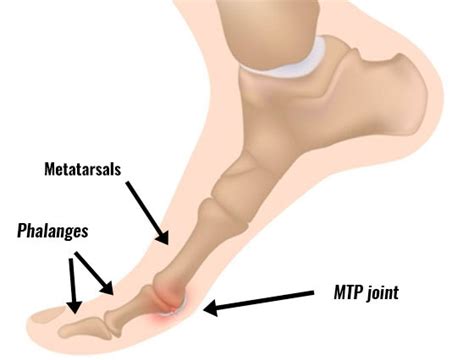 Hallux Rigidus Stiff Big Toe Symptoms Causes And Treatment