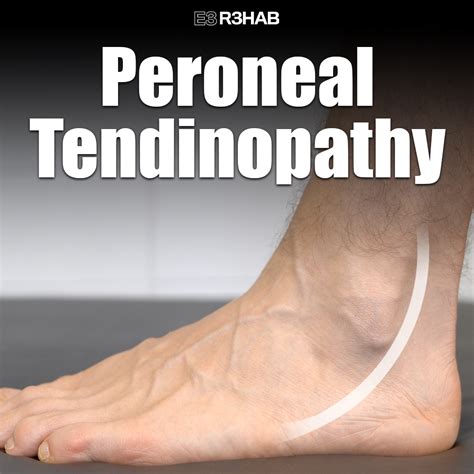 Peroneal Tenosynovitis Treatment