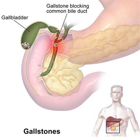 Cholelithiasis Gallstones Causes Symptoms Diagnosis Treatment