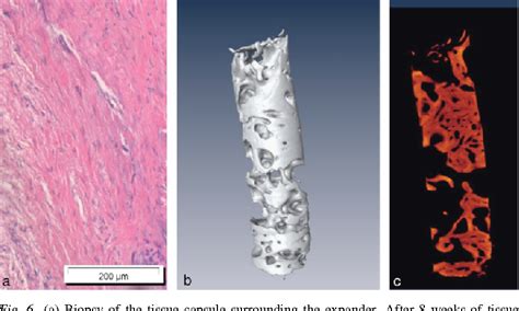 Figure 6 From Soft Tissue Expansion With Self Filling Osmotic Tissue Expanders Before Vertical