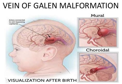 Vein of Galen malformation causes, symptoms, diagnosis, treatment ...