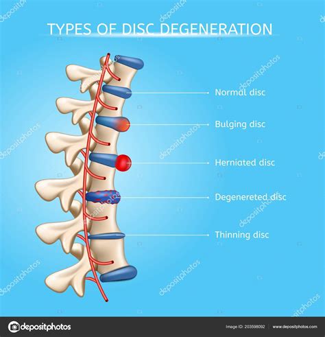 Intervertebral Disc Degeneration Types Vector — Stock Vector