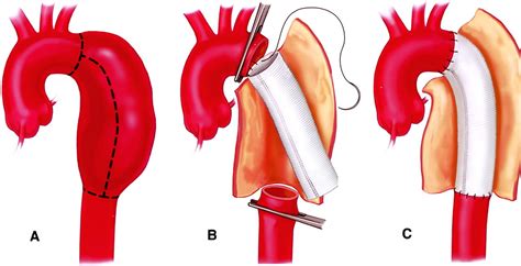 Thoracic and Abdominal Aortic Aneurysms | Circulation