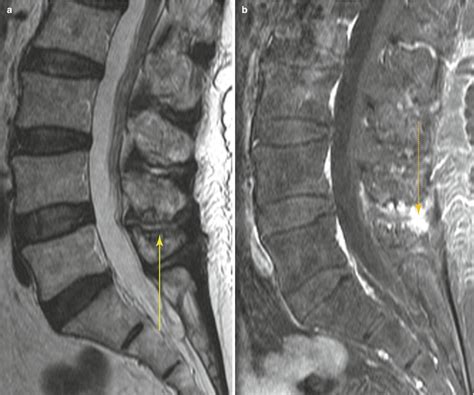 Common Spine Disorders Associated With Back Pain Radiology Key