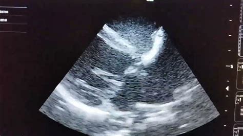 Mitral Valve Prolapse And Regurgitation With And Without Colour Doppler In