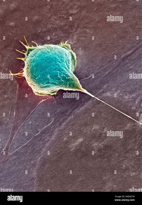 Bladder Cancer Cell Coloured Scanning Electron Micrograph SEM Of A