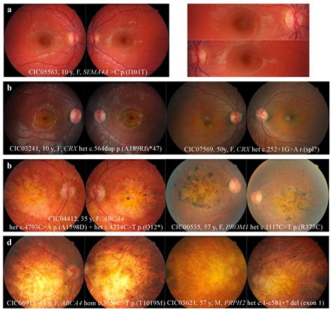 Ijms Free Full Text Phenotype Analysis Of Retinal Dystrophies In