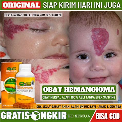 Jual Obat Hemangioma Obat Oles Alami Penghilang Hemangioma Tanda