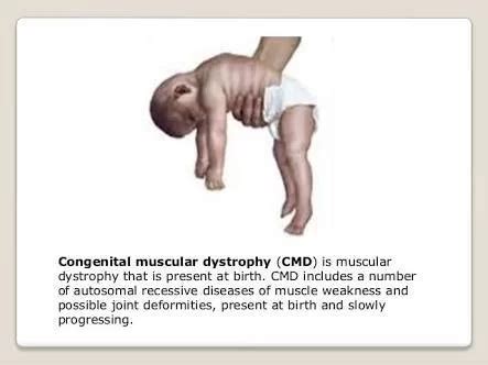 Congenital Muscular Dystrophy(CMD): Causes, Types & Treatment