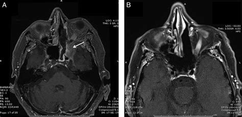 A Axial T1 Weighted Magnetic Resonance Image Mri With Contrast