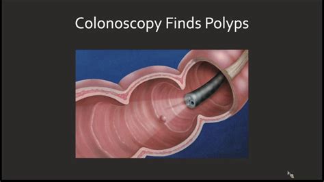 Quality in Colonoscopy: Progress in Colon Cancer Prevention - YouTube