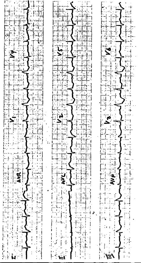 Figure 2 From Interesting Electrocardiogram Intermitrent