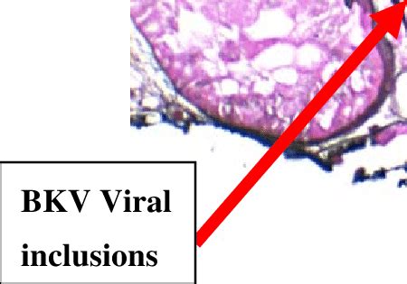 4 Image Of Viral Inclusions And Cellular Changes Typical Of BK Polyoma