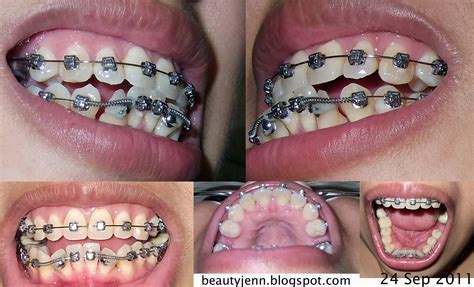 My Lifes Inspirations Damon Braces Update