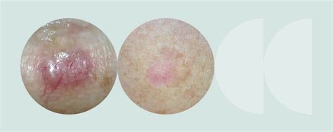 Basal Cell Carcinoma Do You Know The Warning Signs