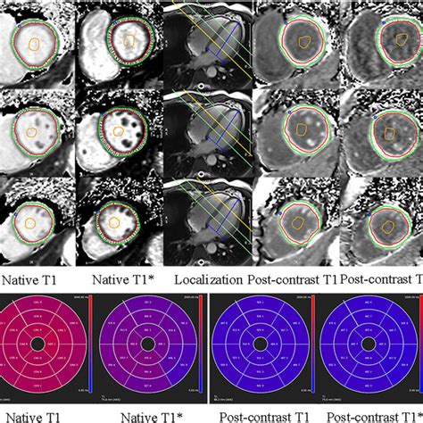 Short Axis T1 And T1 Maps Images Show Example Of Native And