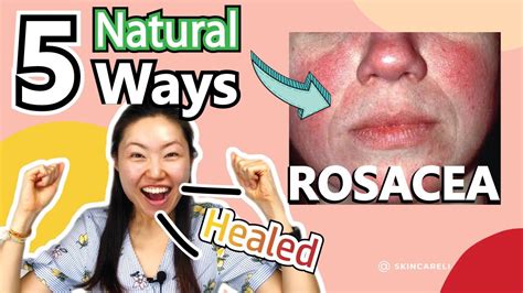 Recover Acne Rosacea Naturally 5 Ways To Heal Your Rosacea Without