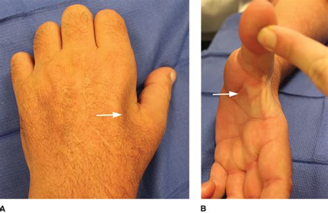 Cubital Tunnel Release Orthoinfo Aaos