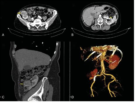 Figure 1 from Aneurisma de arteria renal y carcinoma de células claras