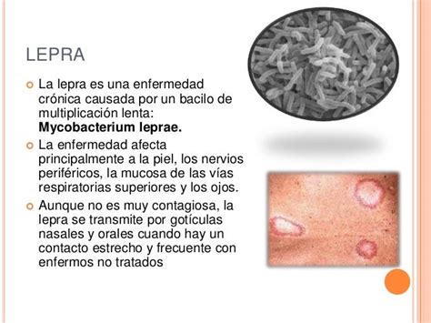 Tuberculosis Y Lepra