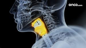 Stage 1 Throat Cancer | Early, localized throat cancer | Onco.com