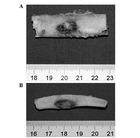 Osteoid Osteoma Of The Rib A Report Of Two Cases