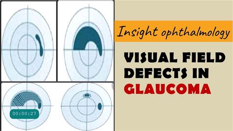 Field Defects In Glaucoma Arcuate Paracentral Nasal Step Temporal