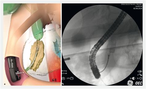 Eus Fna Versus Ercp For Tissue Diagnosis Of Suspect Malignant Biliary Strictures A Prospective