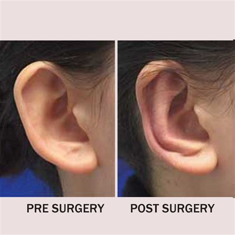 Otoplasty Ear Correction Ear Pinning Cosmetic Ear Surgery In Manchester