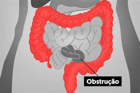 Obstru O Intestinal O Que Sintomas Causas E Tratamento Tua Sa De