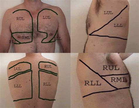 Clin Skills Cxr Pulm Imaging Flashcards Quizlet