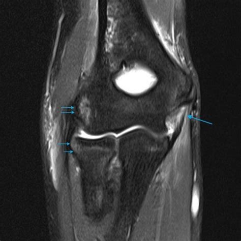 Mri Spine Paediatic Mri Series