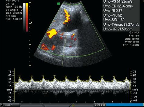 Sagittal Transabdominal Color Doppler Ultrasound Image Showing Uterine