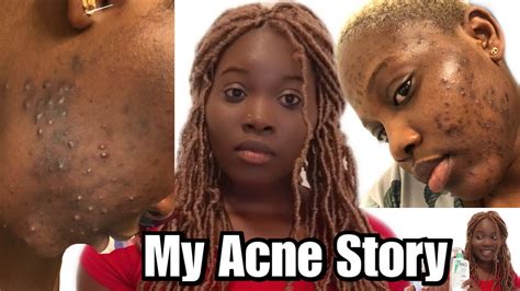 My Acne Story How I Cleared My Acne And Hyperpigmentation Youtube