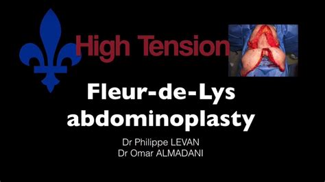 Fleur De Lys Abdominoplasty Youtube