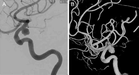 A Pre Operative Conventional Angiography Image Of The Patient A The