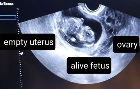 Evidence Of Ovarian Ectopic Pregnancy Ep In The Transvaginal