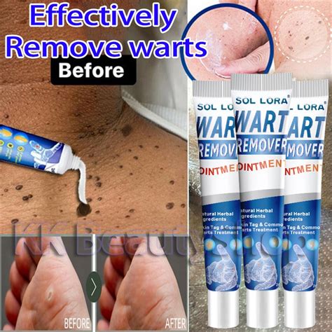 Warts Removal Cream Painless Warts Remover Original Genital Mole Warts