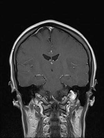 Low Grade Glioma Image Radiopaedia Org