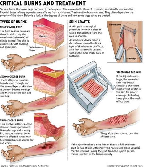 How To Cure Third Degree Burns Partskill30