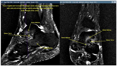 Mri Foot Case Study Greater Waterbury Imaging Center