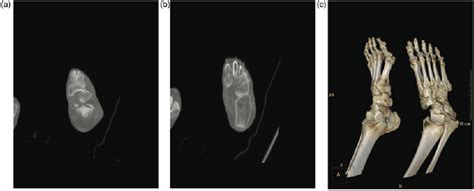 Preoperative Three Dimensional Computed Tomography Ct Images Show