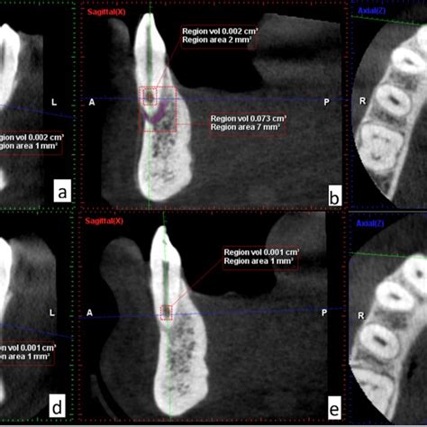 A B C Preoperative CBCT Image With Different Cuts In Mandibular Left