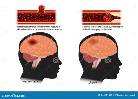 Strokes Classified: Ischemic and Hemorrhagic Stock Vector ...