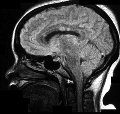 Mri Of Susac S Syndrome Ajr