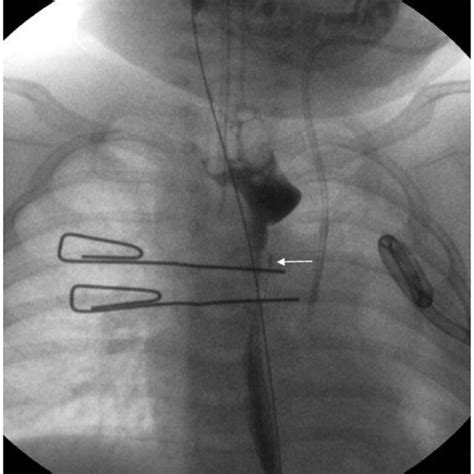 Esophageal Perforation With The Contrast Leak Contained In Left Focal