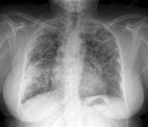 Lung disease, chest X-ray - Stock Image - C013/2194 - Science Photo Library